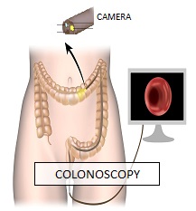 Colonoscopy treatment in pune
